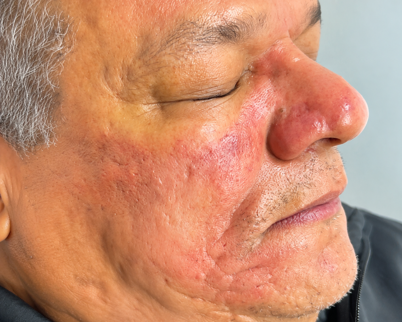 Depois – pele mais uniforme e saudável após o Protocolo Acne