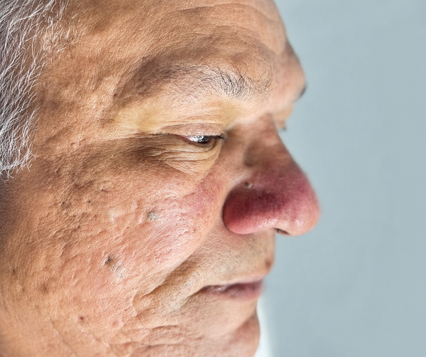 Antes – pele com acne e inflamação antes do Protocolo Acne