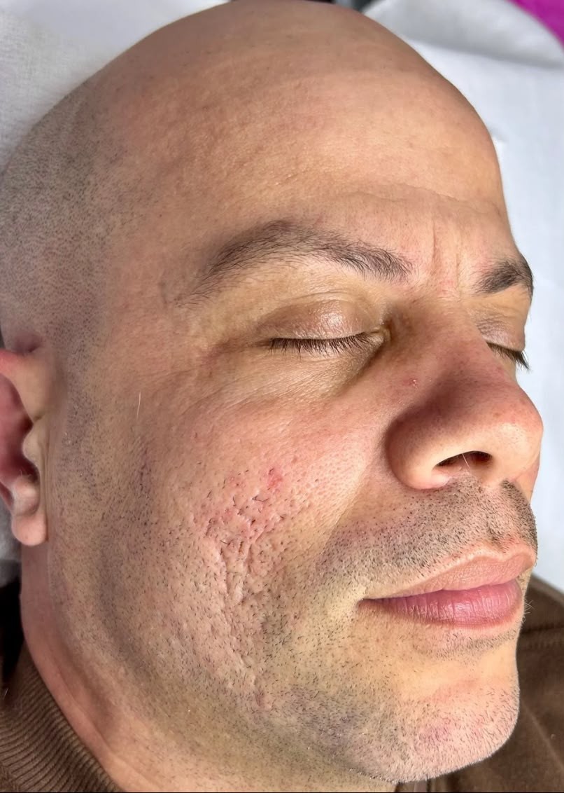 Antes – pele com cicatrizes e textura irregular antes da limpeza de pele coreana e dermaplaning