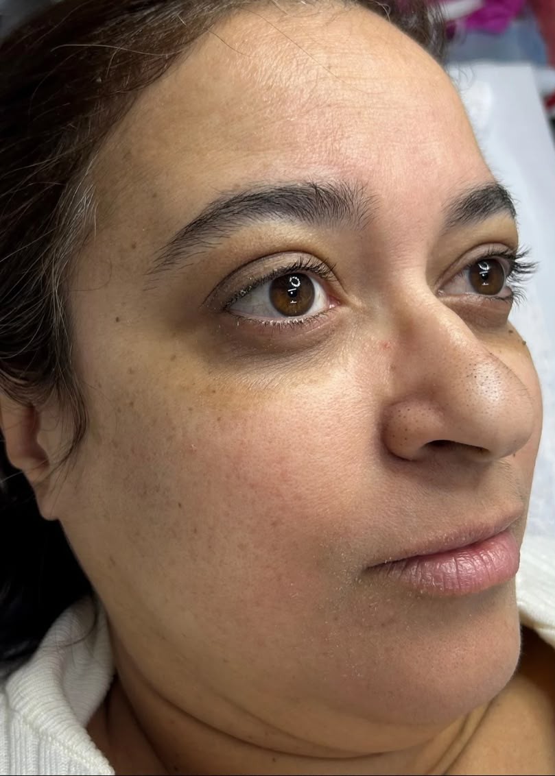 Antes – pele com textura irregular e manchas antes da limpeza de pele coreana e dermaplaning
