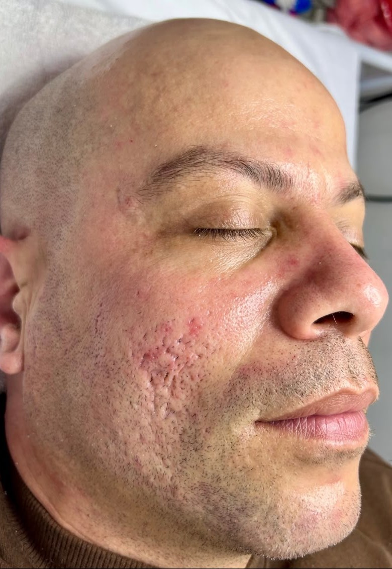 Depois – pele mais lisa e uniforme após limpeza de pele coreana e dermaplaning