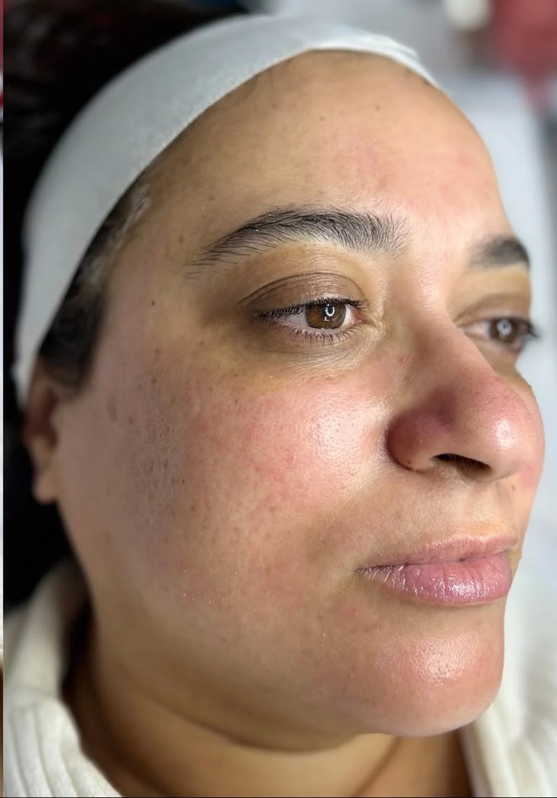 Depois – pele iluminada e uniforme após limpeza de pele coreana e dermaplaning