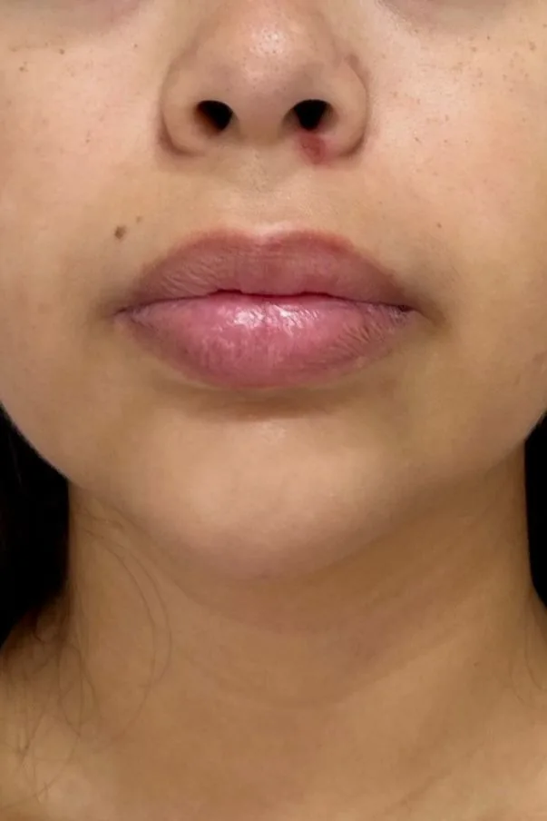 Antes — lábios antes do Hydra Gloss