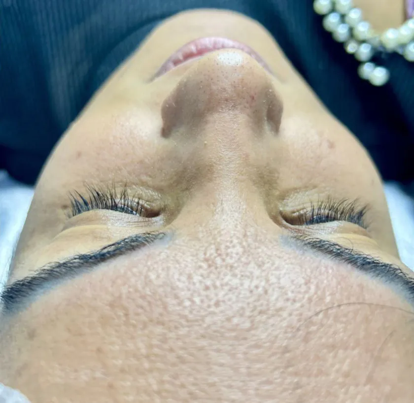 Antes – pele antes da limpeza de pele com peeling