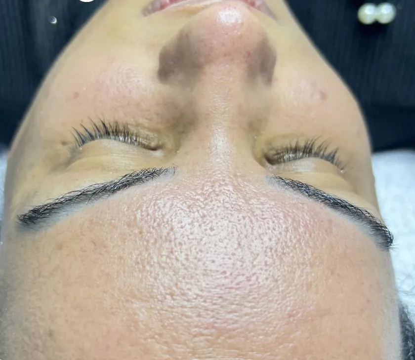 Depois – pele após 1 sessão do Tratamento de limpeza de pele com peeling