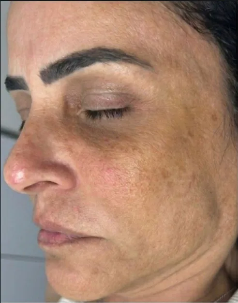 Antes — pele com melasma