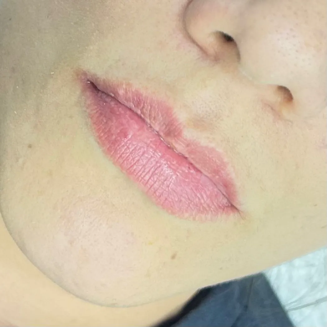 Antes — lábios antes da Micropigmentação Labial