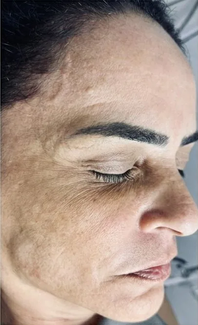 Antes – pele com melasma antes do Tratamento Vulcan