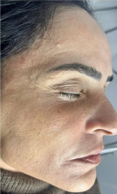 Depois – pele após 1 sessão do Tratamento Vulcan para melasma